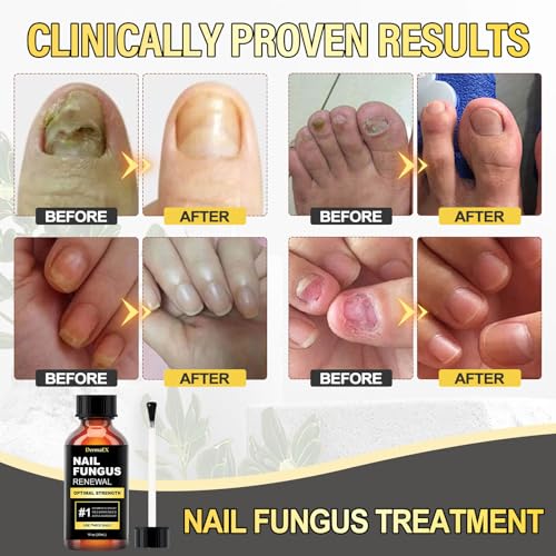 Toenail Fungus Treatment Extra Strength 30ml D405167