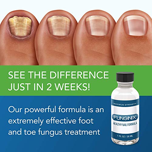 Toenail Fungus Treatment Antifungal Liquid Solution (1 Bottle) F339